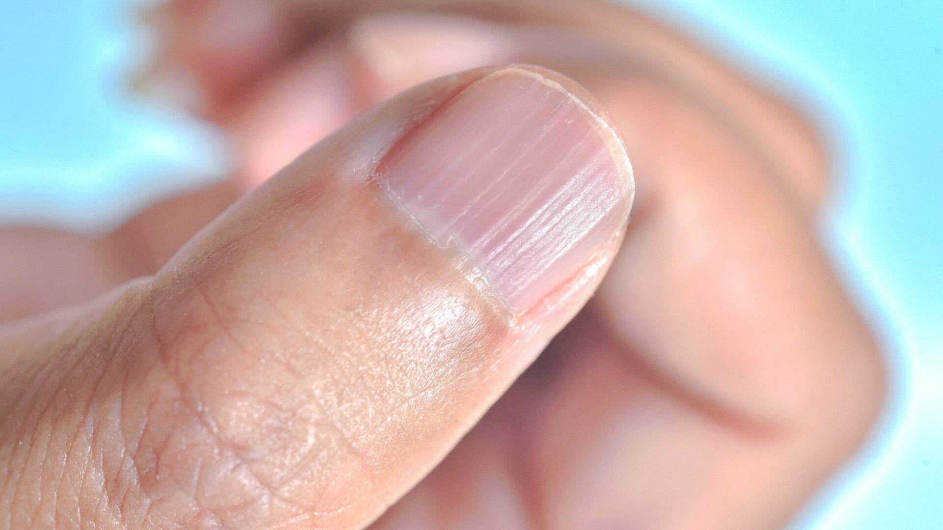Móng gợn sóng, sọc dọc và móng lõm