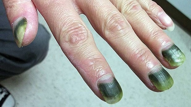 Móng đổi màu do vi khuẩn (Móng xanh – Pseudomonas)